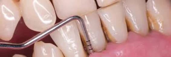 Exploración gingival con sonda periodontal, imagen del documento académico de Periodoncia